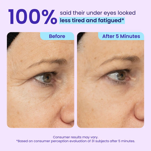 Alvorina™ Eye-Lifter
