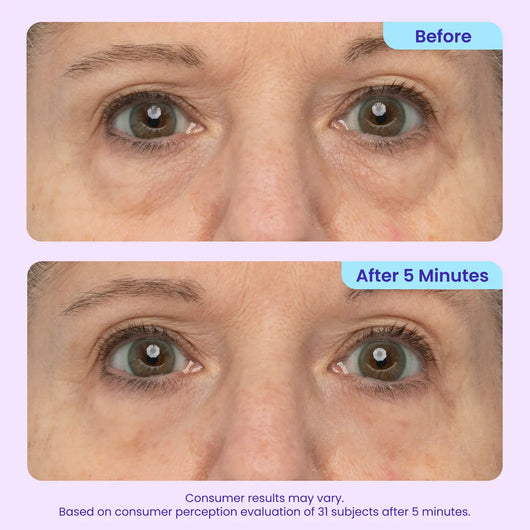 Alvorina™ Eye-Lifter